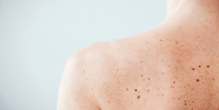 Skin Cancer Awareness