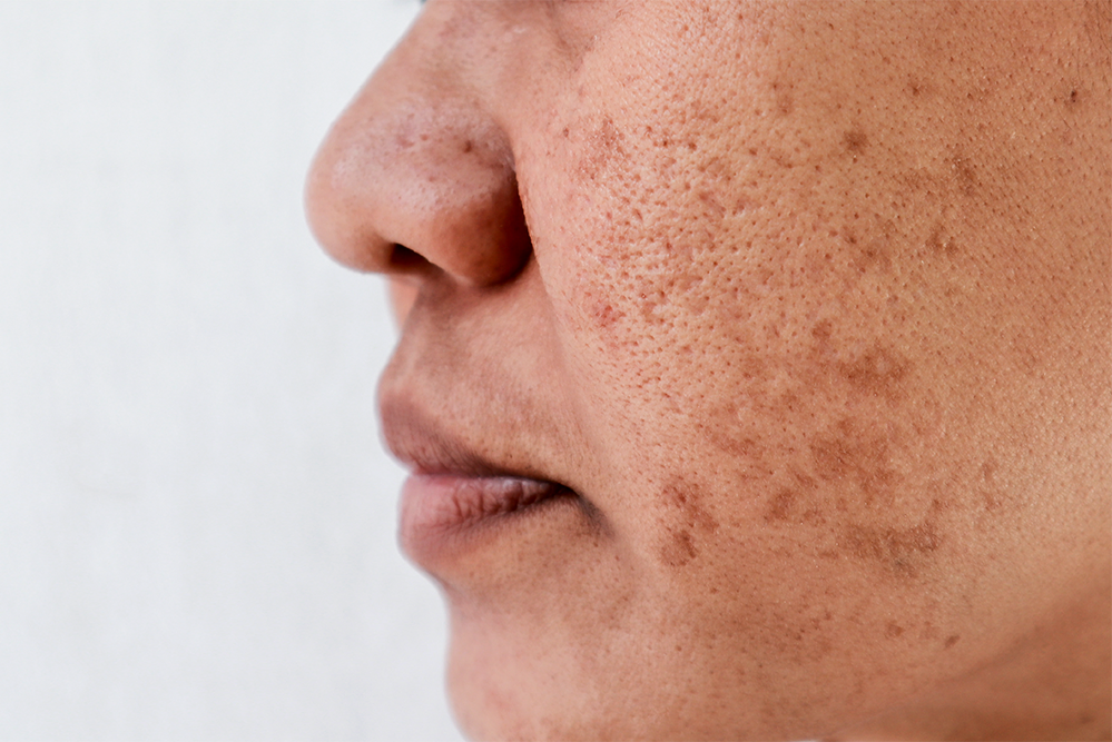 What is Pigmentation?
