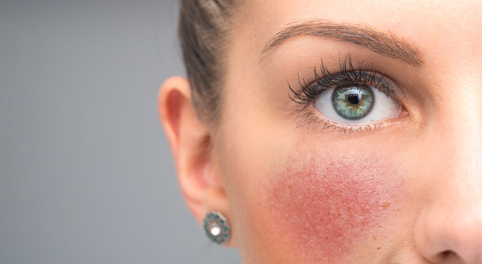 Rosacea and the Demodex Mite