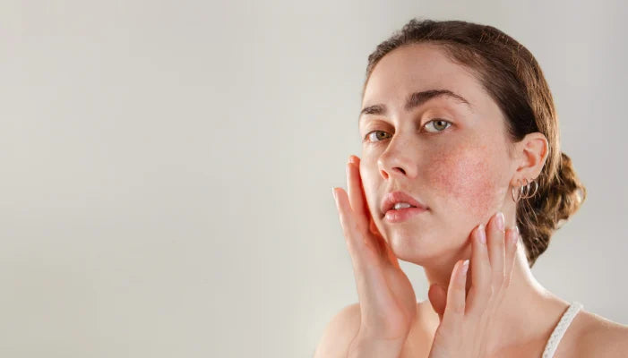 How to Reduce Rosacea Symptoms