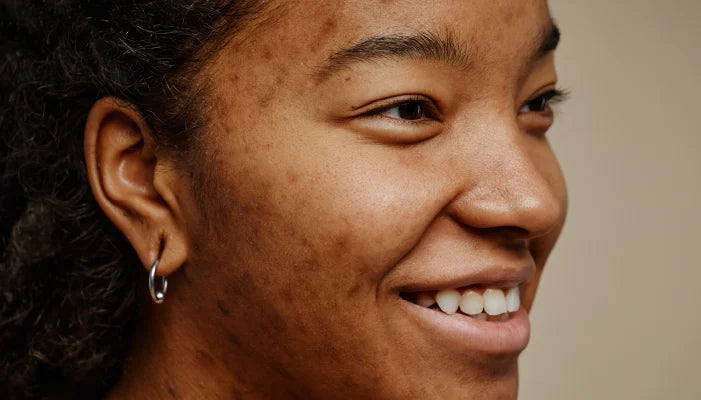 Hyperpigmentation: How to Reduce Dark Spots on your Skin