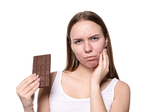 The Misconceptions of Acne